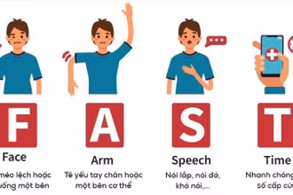 Nguyên tắc FAST của ngành y trong ứng cứu đột quỵ. 