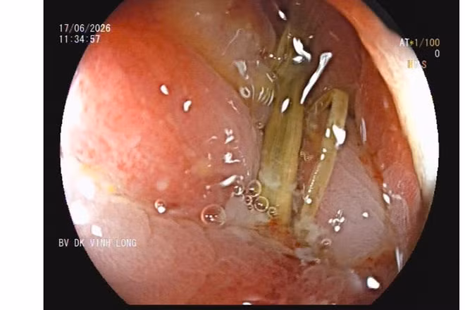Hình ảnh nội soi ghi nhận dị vật dài khoảng 3cm, 1 đầu đâm sâu vào thành đại tràng, có dịch mủ chung quanh.