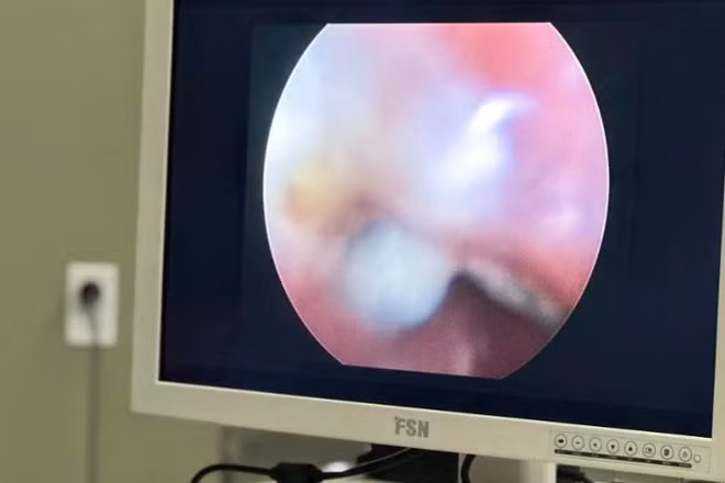 Thiết bị nội soi của Bệnh viện Sản-Nhi Cà Mau giúp phát hiện dị vật trong cơ thể của trẻ. (Ảnh do bệnh viện cung cấp)