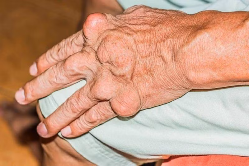 Gout là bệnh lý do sự rối loạn chuyển hóa nhân purin, làm tăng axit uric trong máu.