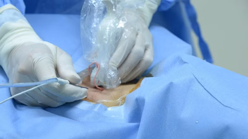 Theo các bác sĩ Bệnh viện Nội tiết Trung ương, kỹ thuật đốt sóng cao tần là một giải pháp đột phá, mang lại hiệu quả cao, an toàn và ít xâm lấn.