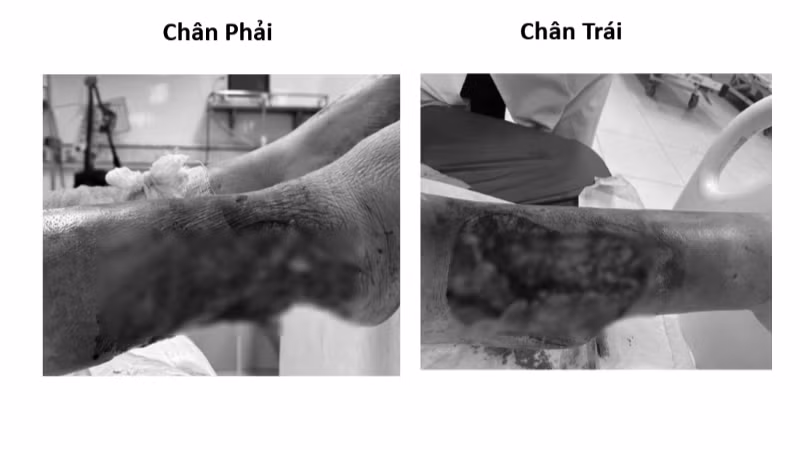 Bệnh nhân nữ nhập viện trong tình trạng tổn thương lóc da vùng cẳng chân hai bên do tai nạn giao thông, vết thương có nguy cơ hoại tử. (Ảnh: BVCC)