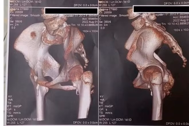 Hình ảnh 3D từ chụp cắt lớp vi tính vùng khớp háng của bệnh nhân với hình ảnh canxi hóa mô mềm quanh khớp. (Ảnh: Bệnh viện cung cấp)