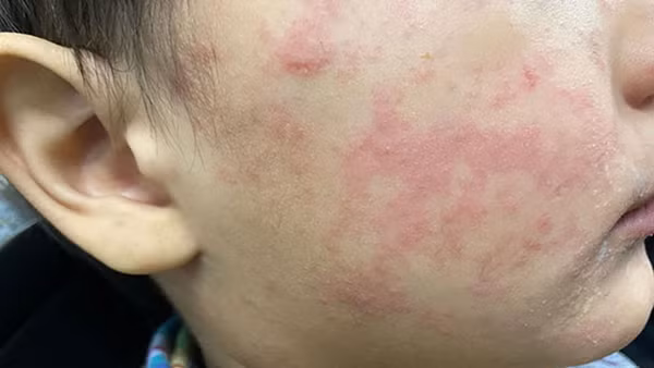 Má của một thiếu niên xuất hiện vết phát ban đặc trưng của bệnh sởi. (Ảnh: CDC Hoa Kỳ).