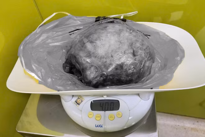 Khối u nặng 4kg. (Ảnh: BV cung cấp)
