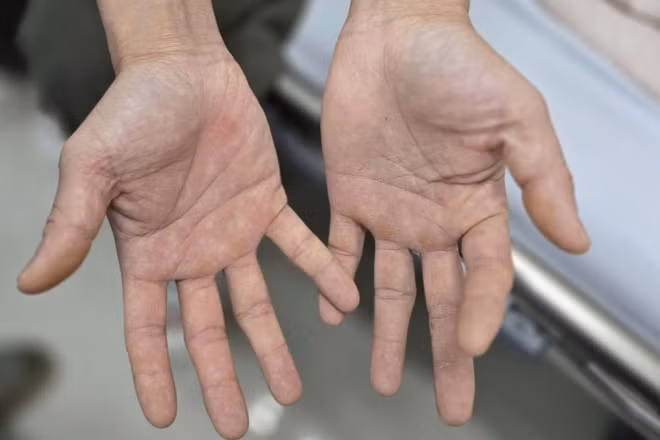 Bàn tay của anh H. bị tê bì, không thể khép lại và mất cảm giác.