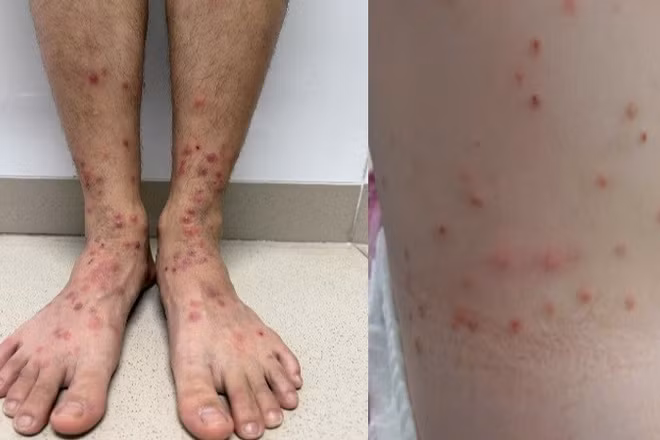 Hình ảnh sẩn ngứa do bọ chét.