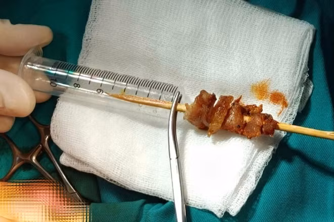 Dị vật gây tổn thương nghiêm trọng cho cháu bé. 
