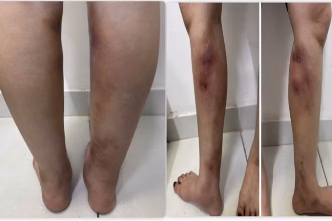 Hình ảnh tổn thương của người bệnh. 