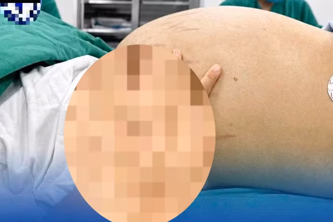 Khối u buồng trứng khổng lồ có đường kính gần 30cm.