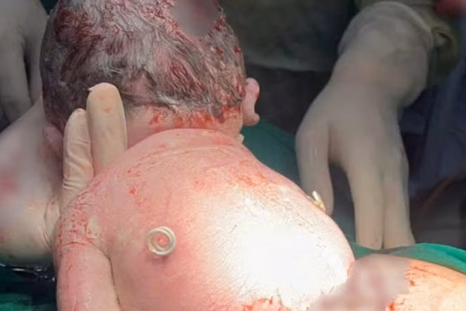 Em bé chào đời với "đôi cánh nhỏ" trên lưng.