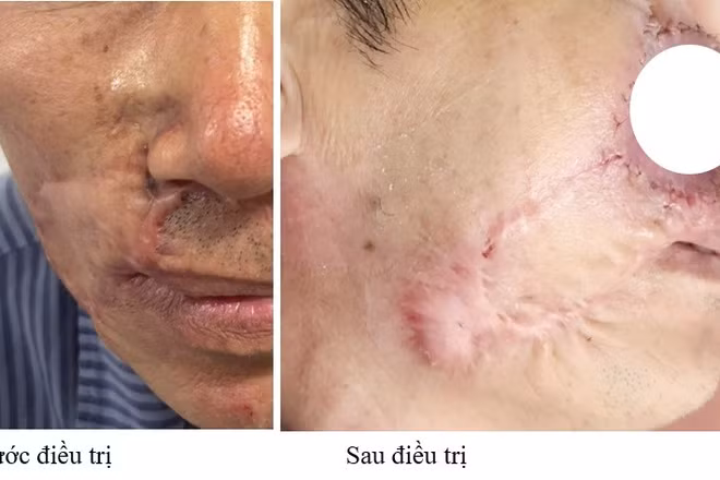 Hình ảnh bệnh nhân trước và sau điều trị. 