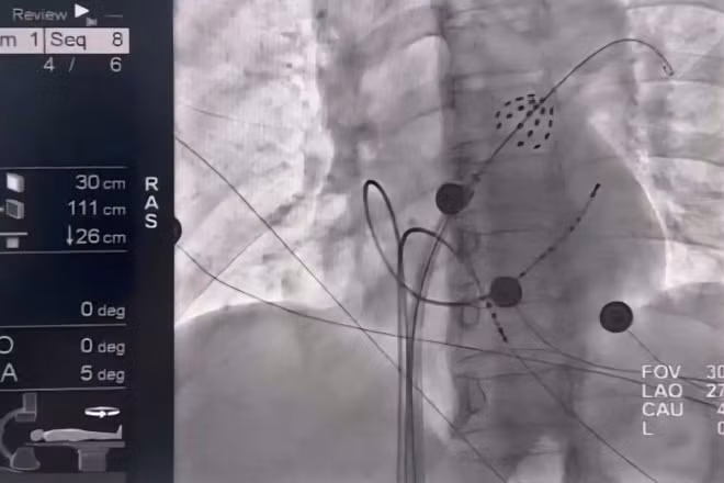 Hình ảnh catheter triệt đốt trong buồng tim, phát xung điện cô lập tĩnh mạch phổi.