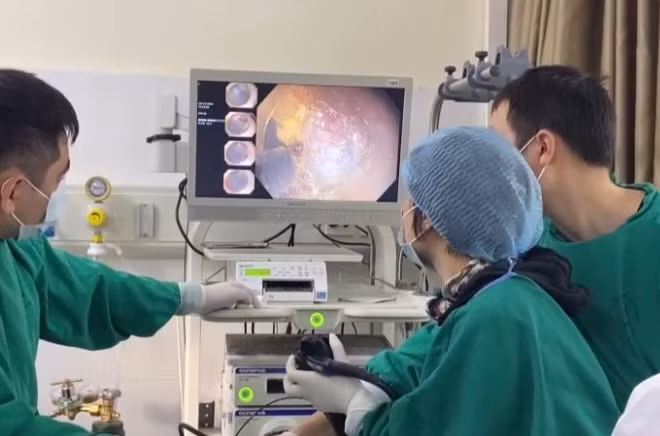 Các bác sĩ Bệnh viện 19-8 nội soi cắt tách dưới niêm mạc điều trị ung thư dạ dày sớm cho bệnh nhân. (Ảnh: cand.com.vn)
