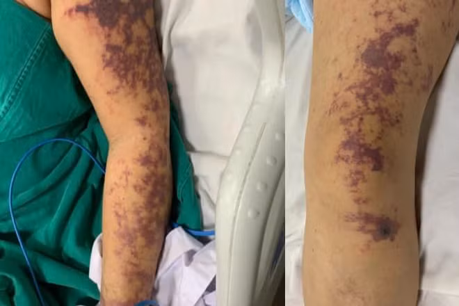 Bệnh nhân có tổn thương da dạng ban tím toàn thân.