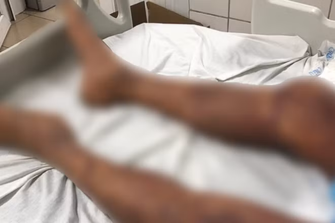 Một trường hợp toàn thân tím đen vì mắc liên cầu lợn. (Ảnh: Vietnam+)