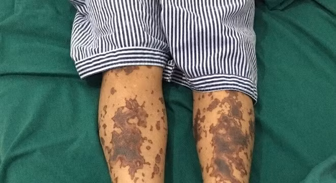 Một bệnh nhân mắc bệnh Liên câu lợn đang được điều trị tại bệnh viện. (Ảnh minh họa)