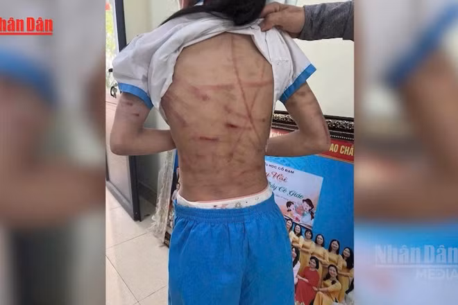 [Video] Bộ Y tế đề nghị lập đường dây nóng 24/7, xử nghiêm mọi hành vi che giấu bạo hành trẻ em