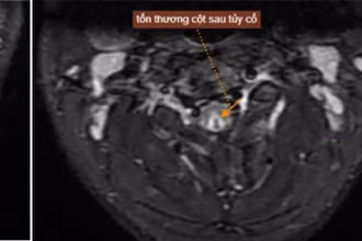 Tổn thương của nam thanh niên sau khi hút bóng cười. 